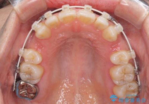 閉じにくい唇を抜歯矯正で閉じやすく 目だたないワイヤー矯正の治療中