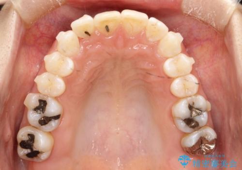 上の前歯が1本前に飛び出している　インビザラインによる目立たない矯正の治療中