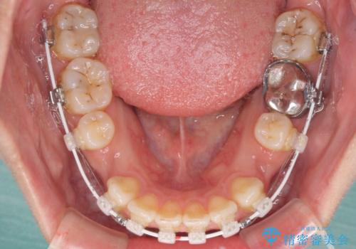 閉じにくい唇を抜歯矯正で閉じやすく 目だたないワイヤー矯正の治療中