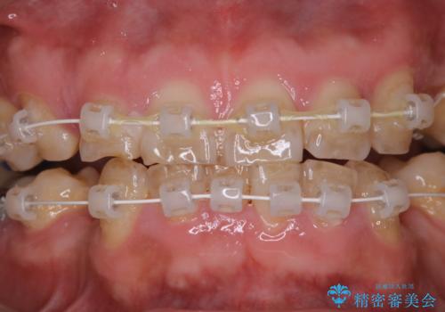 矯正治療中も歯の黄ばみをきれいにしたい
