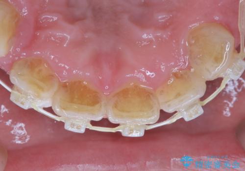 矯正治療中も歯の黄ばみをきれいにしたいの治療前