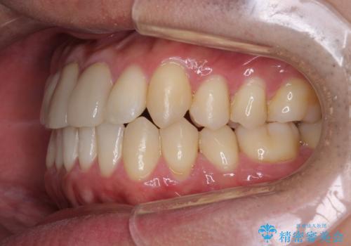 上下のがたつきをインビザラインで目立たない矯正の治療後
