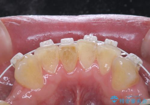 矯正治療中も歯の黄ばみをきれいにしたいの治療前
