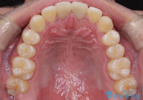 上下のがたつきをインビザラインで目立たない矯正の治療後