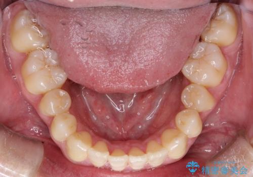 上下のがたつきをインビザラインで目立たない矯正の治療後