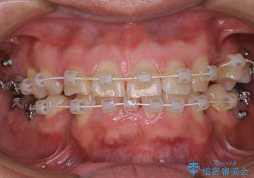 矯正治療中も歯の黄ばみをきれいにしたいの症例 治療後