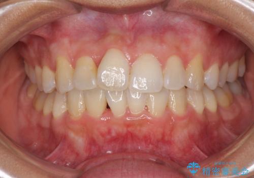 前歯のデコボコをインビザラインでスッキリと仕上げるの治療中