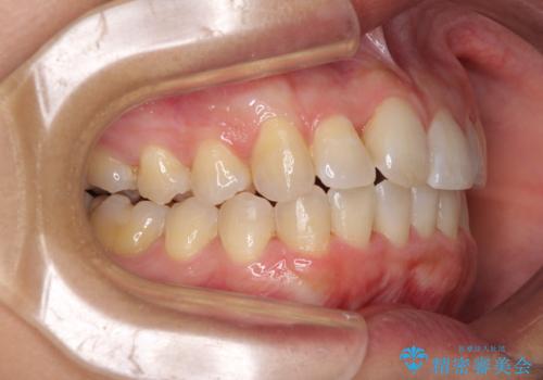 前歯のデコボコをインビザラインでスッキリと仕上げるの治療中