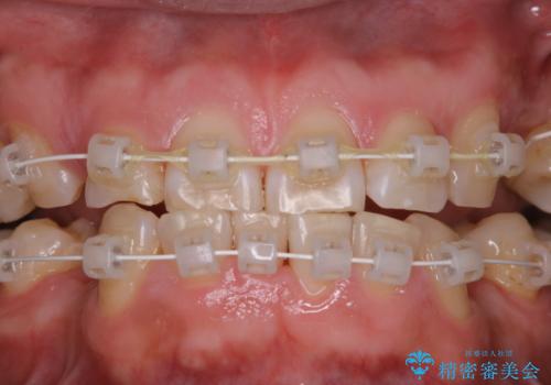 矯正治療中も歯の黄ばみをきれいにしたいの治療後