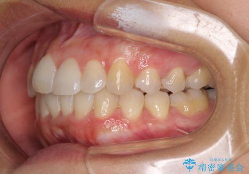 前歯のデコボコをインビザラインでスッキリと仕上げるの治療中