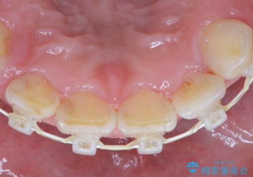矯正治療中も歯の黄ばみをきれいにしたいの治療後