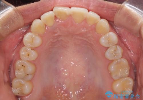 前歯のデコボコをインビザラインでスッキリと仕上げるの治療中