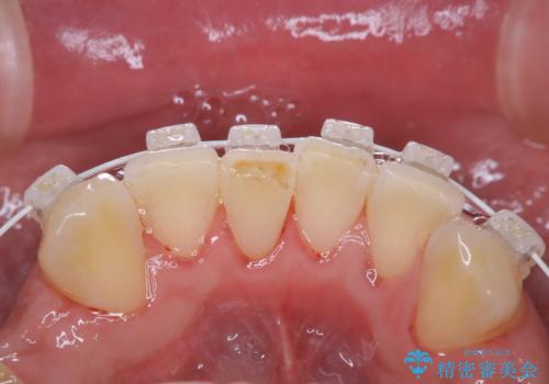 矯正治療中も歯の黄ばみをきれいにしたいの治療後