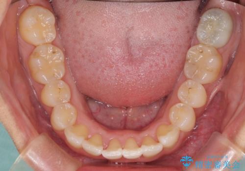前歯のデコボコをインビザラインでスッキリと仕上げるの治療中