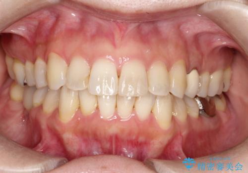 大人の目立たない矯正 インビザラインの症例 治療後