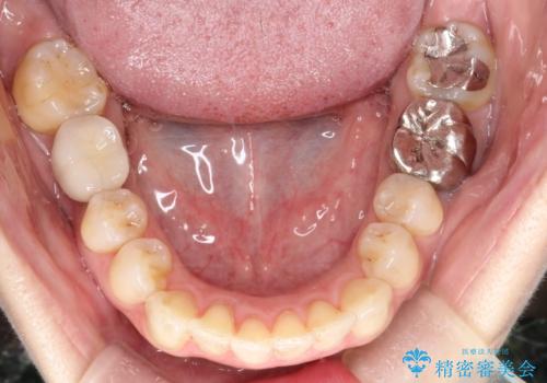 大人の目立たない矯正 インビザラインの治療後