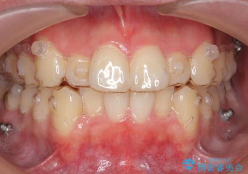 前歯のがたつき　マウスピース矯正で　非抜歯で奥歯を後ろに下げる治療の治療中