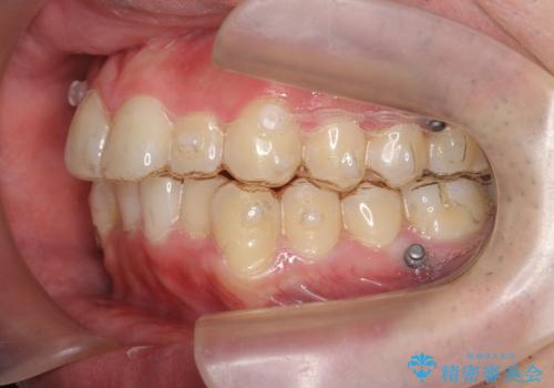 前歯のがたつき マウスピース矯正で 非抜歯で奥歯を後ろに下げる治療の治療中