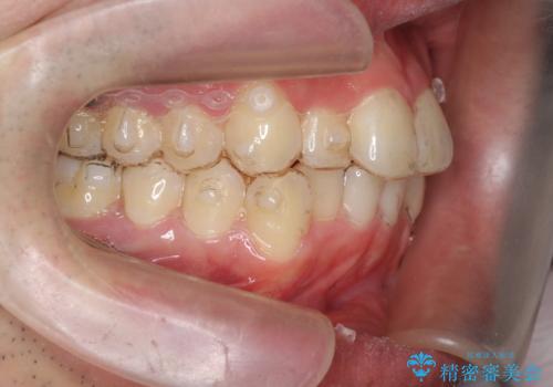 前歯のがたつき　マウスピース矯正で　非抜歯で奥歯を後ろに下げる治療の治療中