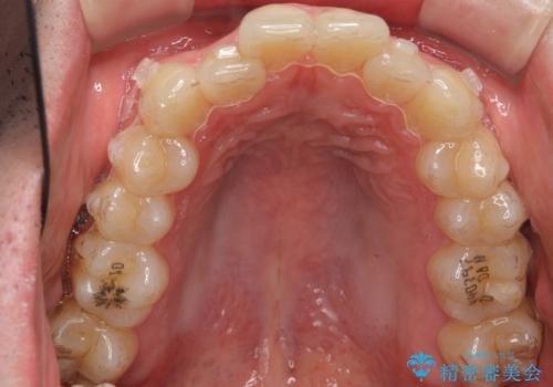 前歯のがたつき マウスピース矯正で 非抜歯で奥歯を後ろに下げる治療の治療中