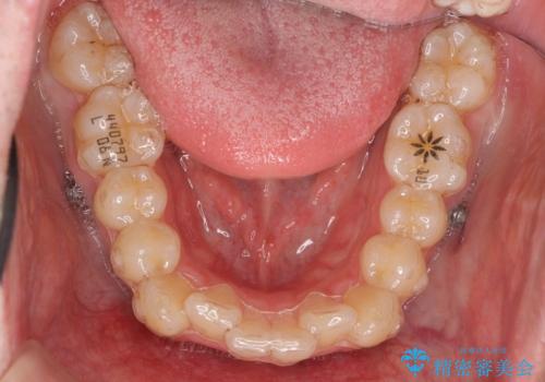 前歯のがたつき マウスピース矯正で 非抜歯で奥歯を後ろに下げる治療の治療中