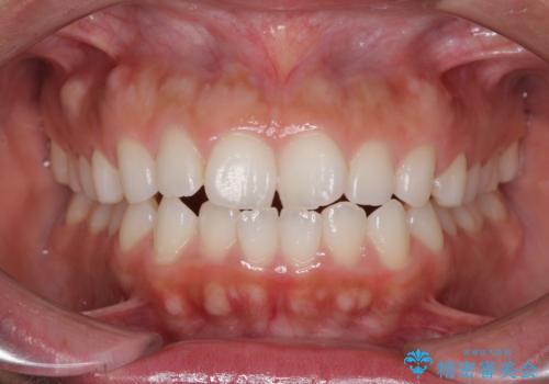 目立たない装置で横顔のシルエットを改善 ハーフリンガルでの抜歯矯正の症例 治療前