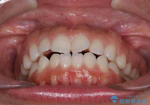 目立たない装置で横顔のシルエットを改善 ハーフリンガルでの抜歯矯正の治療前