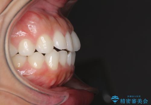 目立たない装置で横顔のシルエットを改善 ハーフリンガルでの抜歯矯正の治療前