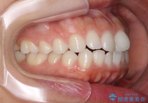 目立たない装置で横顔のシルエットを改善 ハーフリンガルでの抜歯矯正の治療前