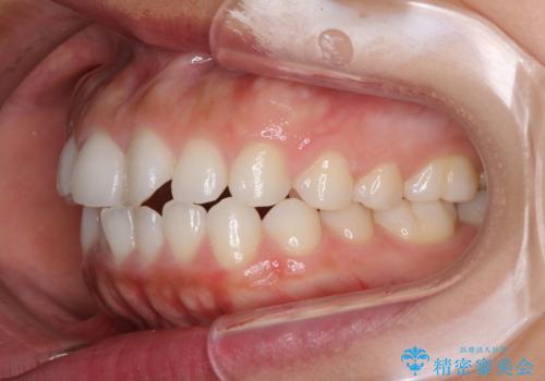 目立たない装置で横顔のシルエットを改善 ハーフリンガルでの抜歯矯正の治療前