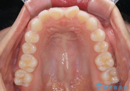 目立たない装置で横顔のシルエットを改善 ハーフリンガルでの抜歯矯正の治療前
