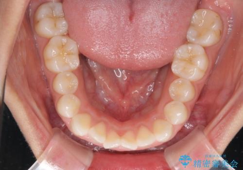 目立たない装置で横顔のシルエットを改善 ハーフリンガルでの抜歯矯正の治療前