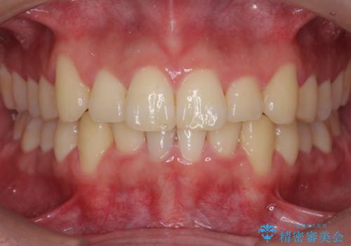 前歯のがたつき　マウスピース矯正で　非抜歯で奥歯を後ろに下げる治療の治療後