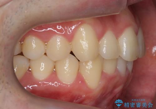 前歯のがたつき マウスピース矯正で 非抜歯で奥歯を後ろに下げる治療の治療後