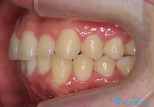 前歯のがたつき マウスピース矯正で 非抜歯で奥歯を後ろに下げる治療の治療後