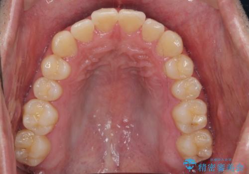 前歯のがたつき　マウスピース矯正で　非抜歯で奥歯を後ろに下げる治療の治療後
