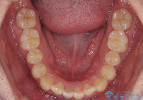 前歯のがたつき マウスピース矯正で 非抜歯で奥歯を後ろに下げる治療の治療後