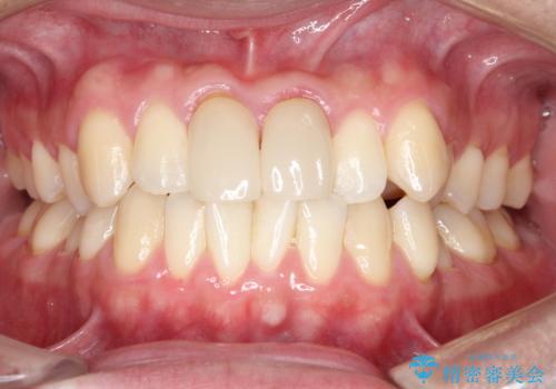 上下のがたつきをインビザラインで目立たない矯正の治療前