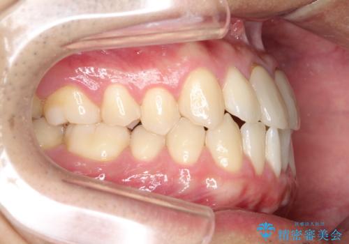 上下のがたつきをインビザラインで目立たない矯正の治療前