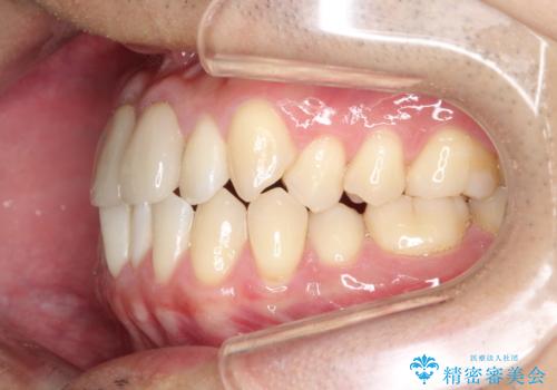 上下のがたつきをインビザラインで目立たない矯正の治療前