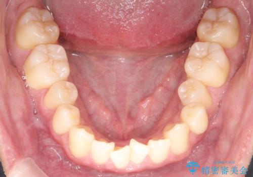 上下のがたつきをインビザラインで目立たない矯正の治療前
