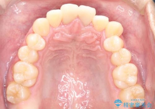 上下のがたつきをインビザラインで目立たない矯正の治療前