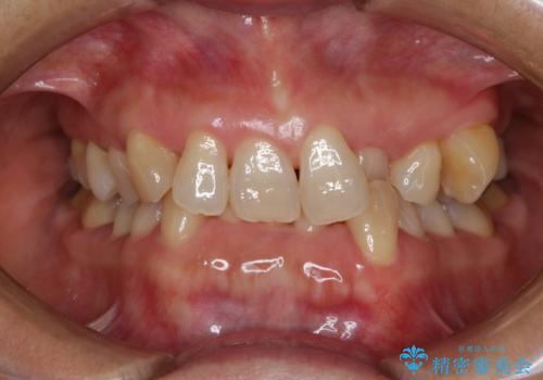下の前歯が見えない:深い噛み合わせもインビザラインでの症例 治療前