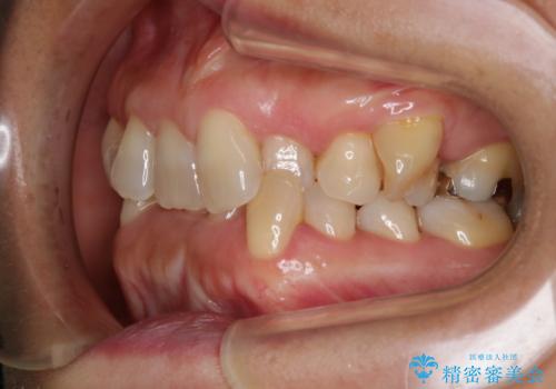 下の前歯が見えない:深い噛み合わせもインビザラインでの治療前