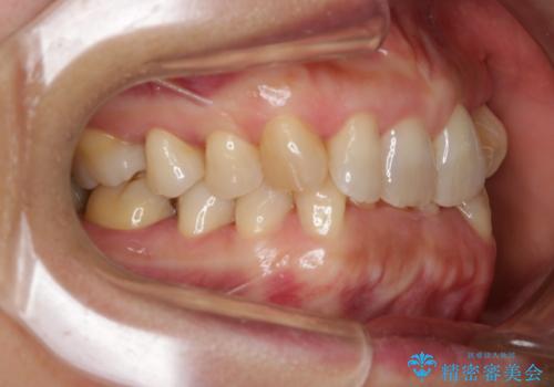 下の前歯が見えない:深い噛み合わせもインビザラインでの治療前