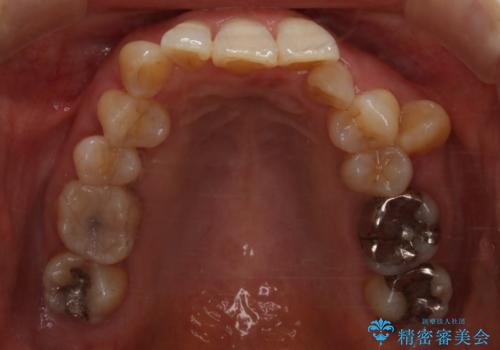 下の前歯が見えない:深い噛み合わせもインビザラインでの治療前
