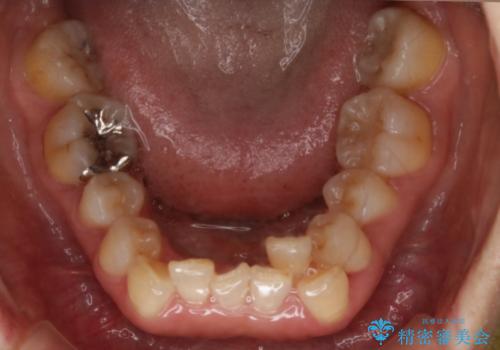下の前歯が見えない:深い噛み合わせもインビザラインでの治療前