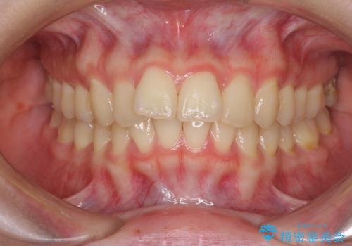飛び出した前歯と黄ばんだ歯 ホワイトニングしながらマウスピース矯正の治療前