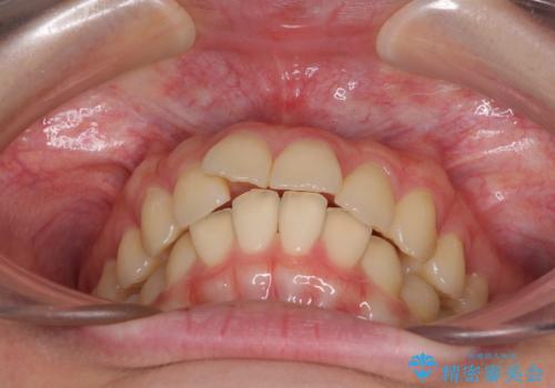 飛び出した前歯と黄ばんだ歯 ホワイトニングしながらマウスピース矯正の治療前