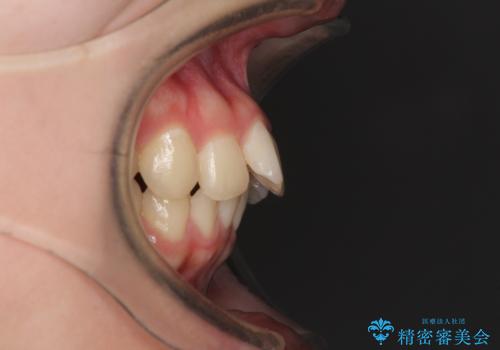 飛び出した前歯と黄ばんだ歯 ホワイトニングしながらマウスピース矯正の治療前